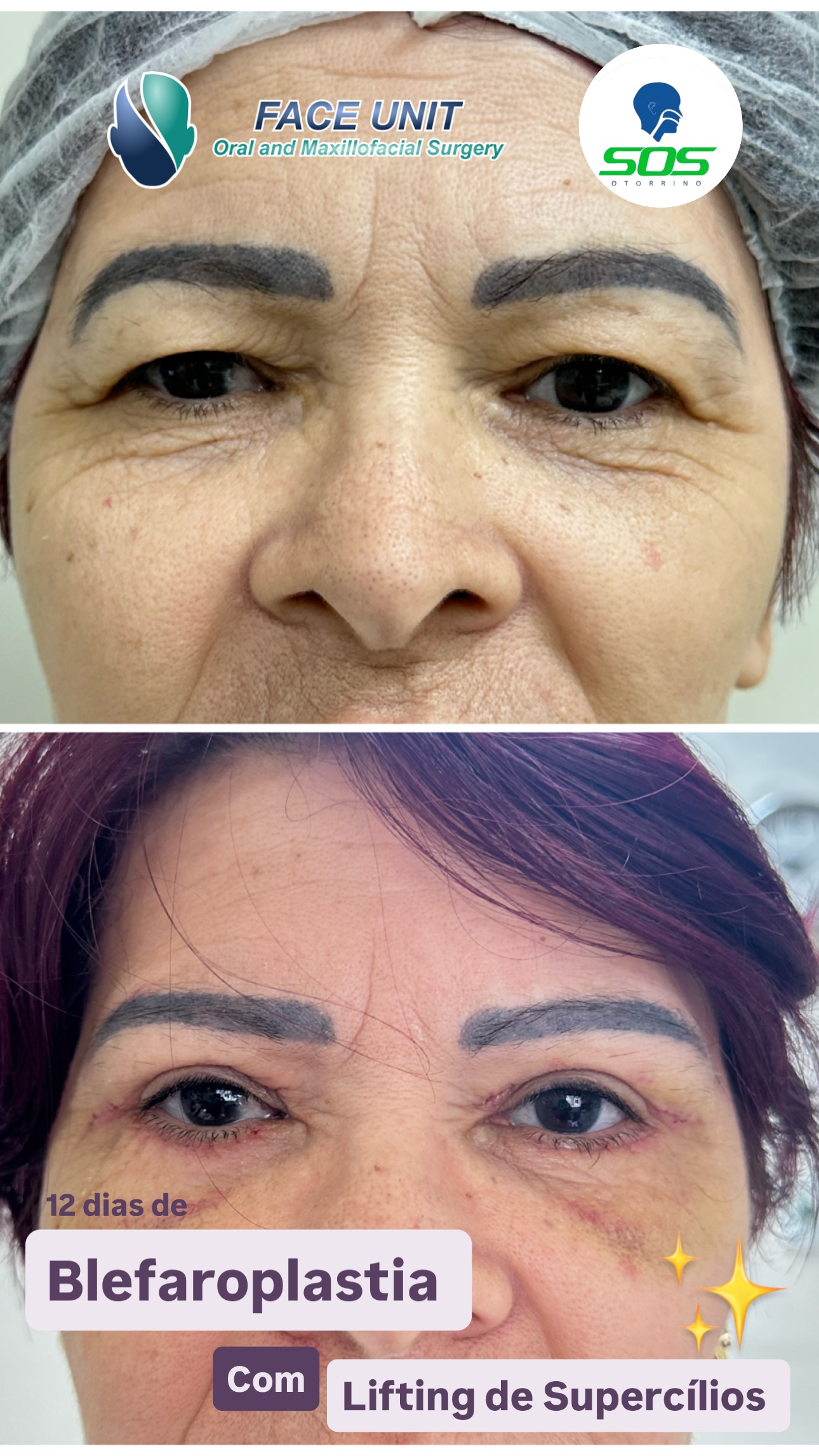 Blefaroplastia Caso