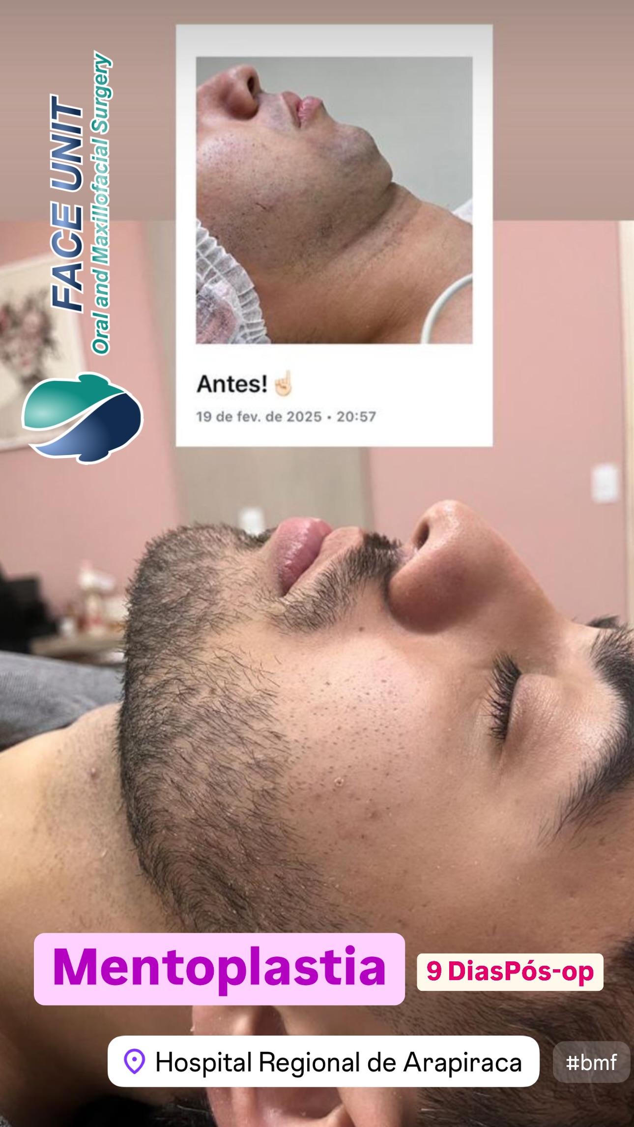 Mentoplastia Caso