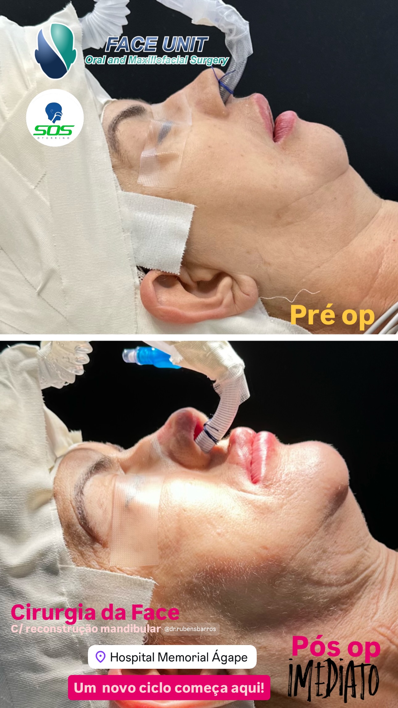 Mentoplastia Caso